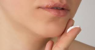 how are cold sores and pimples diffe