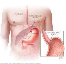 Symptoms of early stomach cancer can be similar to the symptoms of other conditions, such as stomach ulcers. Stomach Cancer Symptoms And Causes Mayo Clinic