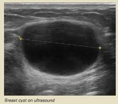 Guides you through breast cancer screening choices if you have dense breasts. Breast Cyst Fact Sheet Westmead Bci