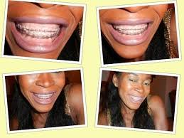How to whiten teeth fast. 109 My Teeth Whitening Methods Even With Braces On Youtube