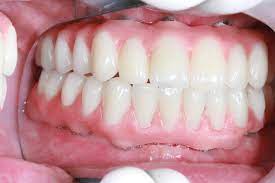 full mouth dental implants in mexico