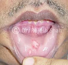 recur mouth ulcers treatment