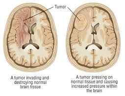 Brain Tumor Guide Causes Symptoms And Treatment Options