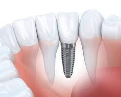 Dental implants can improve your speech