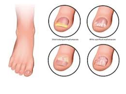 preventing toenail problems