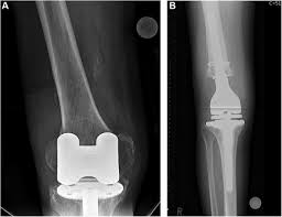 revision total knee arthroplasties