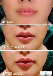 lip filler youth beauty clinic