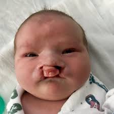 cleft lip and palate a mother s