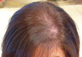 hair loss causes treatments toppik