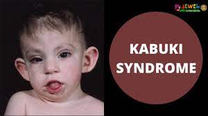 kabuki syndrome signs and symptoms of