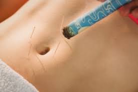 Since 1997 we have manufactured innovative designs for professional piercers worldwide. Navel Acupuncture Best Acupuncture Hamilton Nz