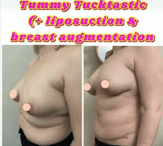 liposuction harley clinic