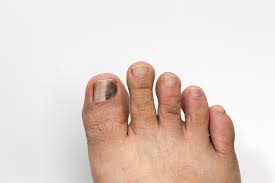 the black toenail a runners right of