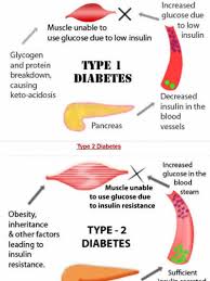 Diabetes And Your Eyesight Level Sugar Chart Australia Blood