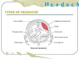 Headache Location Chart