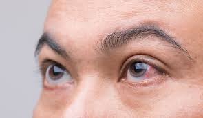 swollen eyelid causes symptoms and