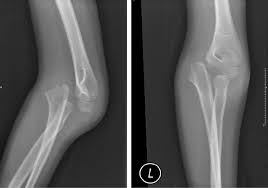 De wikipedia, la enciclopedia libre. Anterior Elbow Fracture Dislocation With Ulnar Nerve Palsy In A Six Year Old Child Ashar Pediatric Traumatology Orthopaedics And Reconstructive Surgery