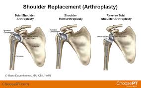 shoulder replacement arthroplasty