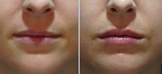 lip fillers at mh clinic seoul