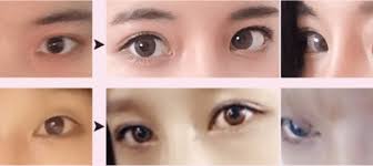 double eyelid surgery in korea