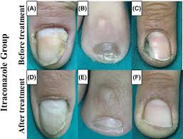 q switched nd yag laser versus