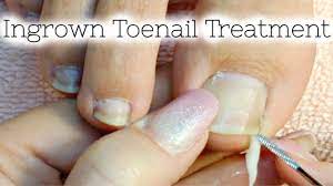 pedicure tutorial ingrown toenail