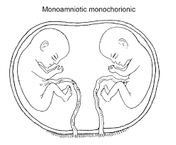 Types Of Twins Dizygotic Monozygotic Dichorionic