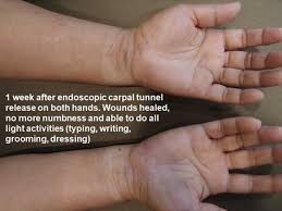 carpel tunnel syndrome hand numbness