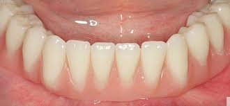 Dentures are full or partial dental prosthesis to replace your missing teeth. Cad Cam Bei Der Versorgung Von Minimaldurchmesserimplantaten Implantologie Dimagazin Aktuell De
