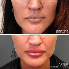 juvederm ultra plus for lip injections