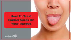 how to treat canker sores on your tongue
