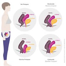 safe exercises for pelvic organ prolapse