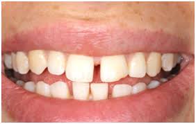 Plus, veneers correct any other cosmetic issues that are on your radar, like chips, discoloration, short teeth, misalignment, and more. Gap Between Your Teeth Let Orthodontics Straighten That Out