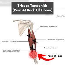 triceps tendonitis a helpful guide for