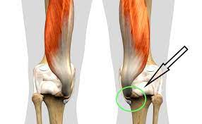low hamstring tendonitis a cause of