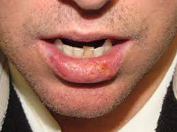 squamous cell carcinoma lower lip