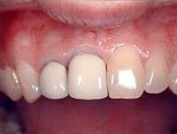 Pfm Crown Dental Crowns Dental Charting Dental