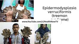 Epidermodysplasia verruciformis (ev), also known as tree man syndrome, is a genetic dermatologic condition. Epidermodysplasia Verruciformis Treeman Medical Conditioning Disease Doctor Shocking Syndrome Healthnowtv Medical Syndrome Disease