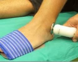 Image of Physiotherapy for Ankle Sprains