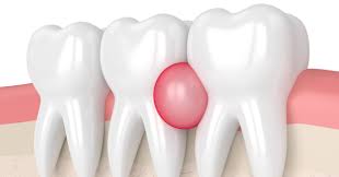 gum abscess symptoms types causes