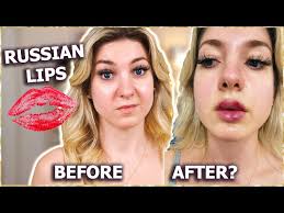 my russian lip filler experience you