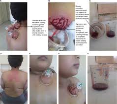 Full Text Al Hijamah Wet Cupping Therapy Of Prophetic