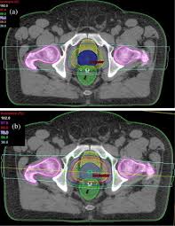 spot scanning proton beam therapy for