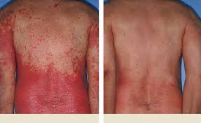 plaque psoriasis pictures before