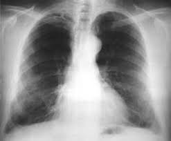 Pleural mesothelioma is the only known pleural cancer and is caused by asbestos exposure in nearly all cases. Asbestos Is The Generic Term Used For The Group Of Fibrous Mineral Silicates Of Magnesium And Iron Whose Chemical And Physical Properties Make It Ideal For A Variety Of Commercial And Industrial Uses Asbestos Is Derived From The Greek Word Meaning