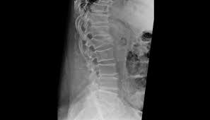 Osteoporosis (a condition which weakens the bones), a very hard fall, excessive pressure, or some when a bone in the spine collapses, it is called a vertebral compression fracture. Ortho Dx Lumbar Compression Fracture Clinical Advisor