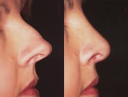 my nose without surgery rhinoplasty