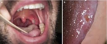 bacterial infections of the mucosa
