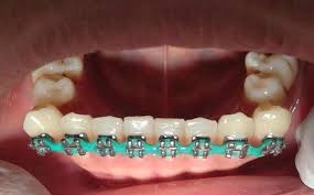 How do i know if i need braces? Reddit Braces See That S What The App Is Perfect For
