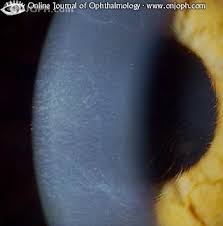 Recurrent corneal erosions are small defects in the surface of the cornea. Atlas Of Ophthalmology